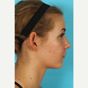 25-34 year old woman treated with Rhinoplasty after 3629399