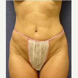 45-54 year old woman treated with Mini Tummy Tuck before 2066865