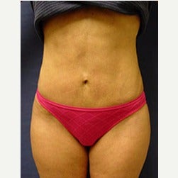 45-54 year old woman treated with Mini Tummy Tuck after 2066865