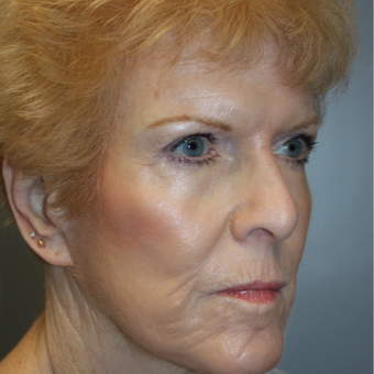 65-74 year old woman treated with Fraxel Laser after 3808376
