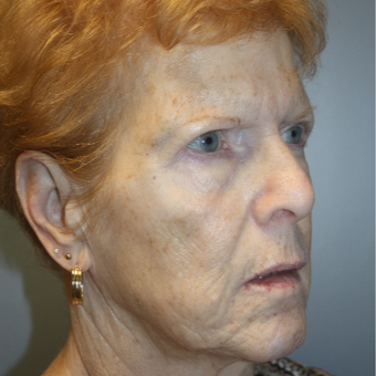 65-74 year old woman treated with Fraxel Laser before 3808376