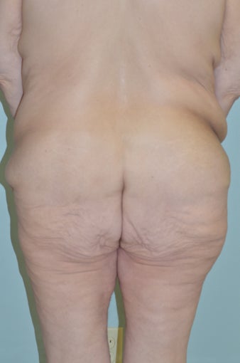 Lower body lift and breast augmentation 1059218