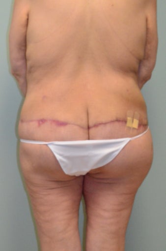 Lower body lift and breast augmentation 1059218