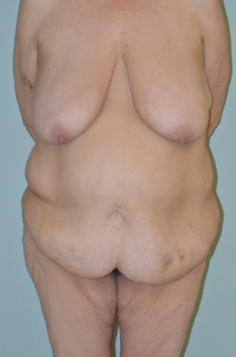 Lower body lift and breast augmentation before 1059218