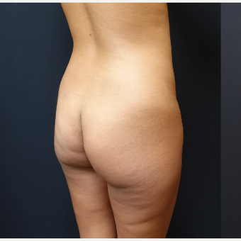 25-34 year old woman treated with SAFELipo before 3732068