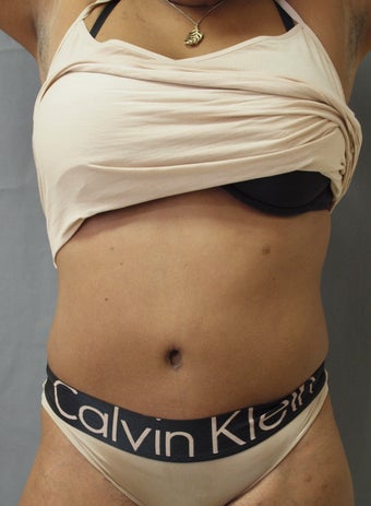 Revision of Abdomen from a "Cosmetic Surgeon" after 927481