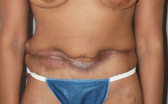 Revision of Abdomen from a "Cosmetic Surgeon" before 927481