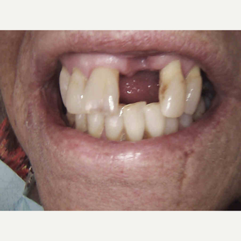 55-64 year old woman treated with Dental Crown before 2879755