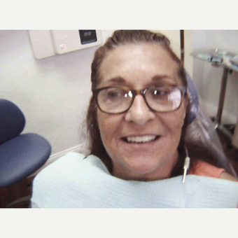 55-64 year old woman treated with Dental Crown after 2879755