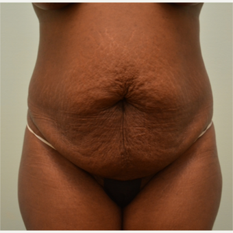 Embrace Scar Therapy used to minimize scarring from tummy tuck and liposuction. before 3287786