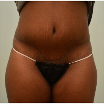 Embrace Scar Therapy used to minimize scarring from tummy tuck and liposuction. after 3287786