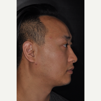 35-44 year old man treated with Rhinoplasty 8 months post-op after 3499931