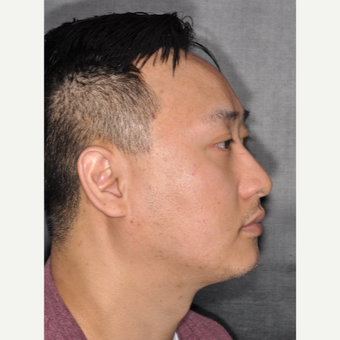 35-44 year old man treated with Rhinoplasty 8 months post-op before 3499931
