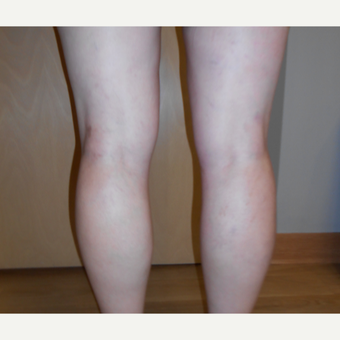45-54 year old woman treated with Vein Treatment after 3161497