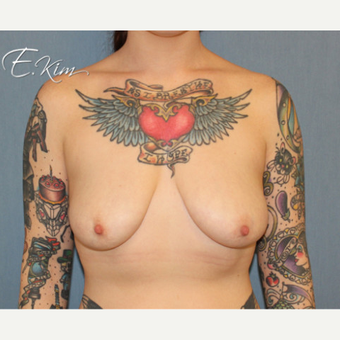 25-34 year old woman treated with Breast Lift with Implants before 3663435