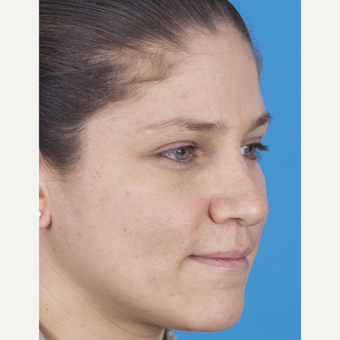 25-34 year old woman treated with Rhinoplasty before 3159497