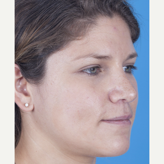 25-34 year old woman treated with Rhinoplasty after 3159497