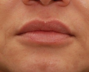 45-54 year old woman treated with Lip Augmentation after 3032136