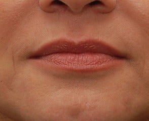45-54 year old woman treated with Lip Augmentation before 3032136