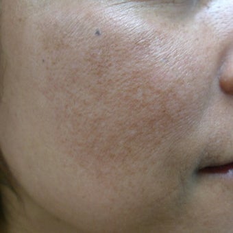 laser for melasma after 1936089