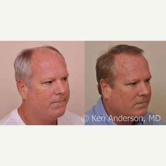 50 year old - Hair Transplant - 6 months progress photos - MORE HAIR to come in the next 6-9 months after 3027846
