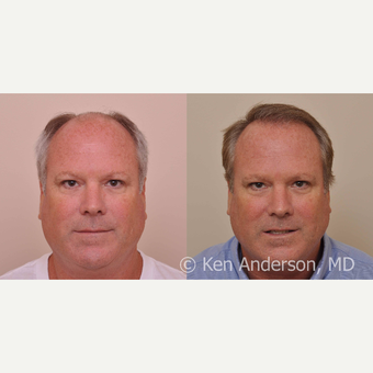 50 year old - Hair Transplant - 6 months progress photos - MORE HAIR to come in the next 6-9 months before 3027846