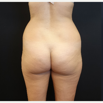 25-34 year old woman treated with Tumescent Liposuction before 3629909