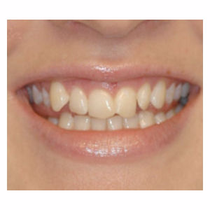 Crowded teeth treated with Clear Braces before 3696137