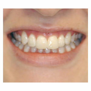Crowded teeth treated with Clear Braces after 3696137