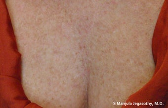 Sun Damage Treated with VBeam® Laser before 1709367