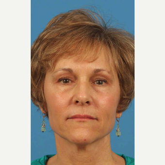 55-64 year old woman treated with Upper Eyelid Surgery after 3787468