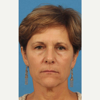 55-64 year old woman treated with Upper Eyelid Surgery before 3787468