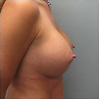 37 year old woman treated with Breast Augmentation after 3468352