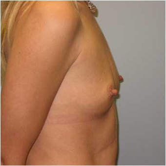 37 year old woman treated with Breast Augmentation before 3468352