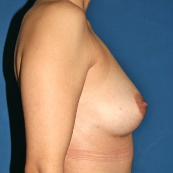 Natural Breast Augmentation through Fat Transfer surgery after 988368