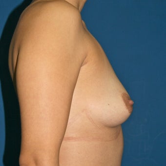 Natural Breast Augmentation through Fat Transfer surgery before 988368