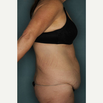 45-54 year old woman treated with Body Lift before 3442433