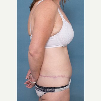 45-54 year old woman treated with Body Lift after 3442433