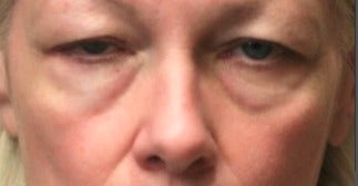55-64 year old woman treated with Laser Resurfacing before 3046891