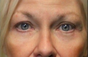 55-64 year old woman treated with Laser Resurfacing after 3046891