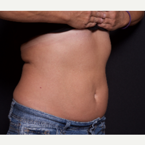55-64 year old woman treated with SculpSure after 3584203