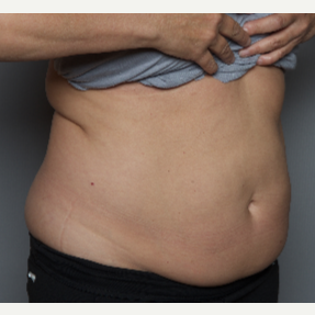 55-64 year old woman treated with SculpSure before 3584203