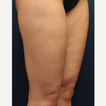 35-44 year old woman treated with Cellulaze before 3142616