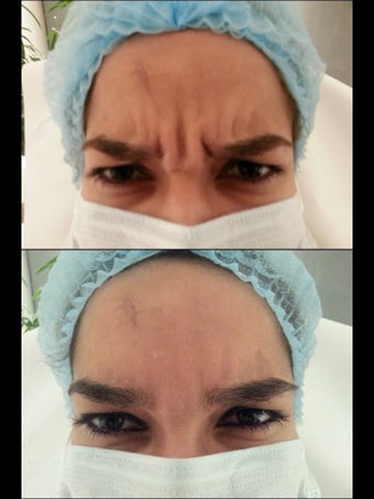 25 yrs old female wit forehead wrinkles before 703901