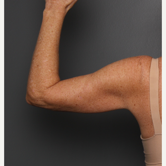 Arms after 3803314