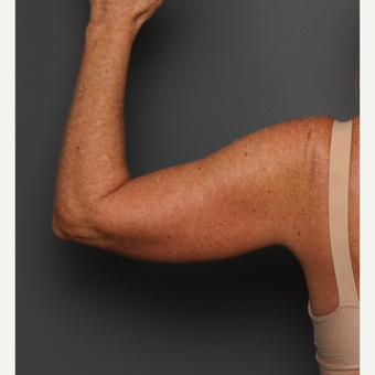 Arms before 3803314