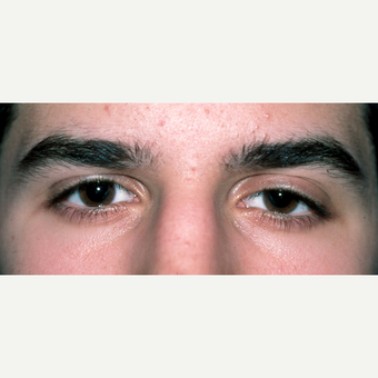 Congenital ptosis treated in early adulthood for young male before 2826106