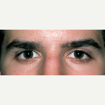 Congenital ptosis treated in early adulthood for young male after 2826106
