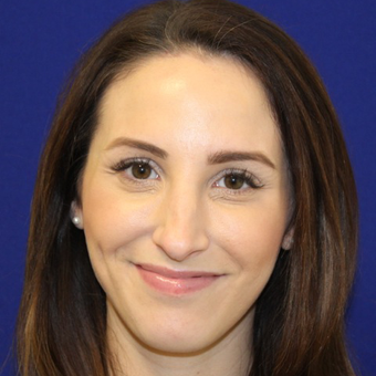 29 year old woman treated with Botox after 3836800