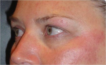 Restylane before 675897